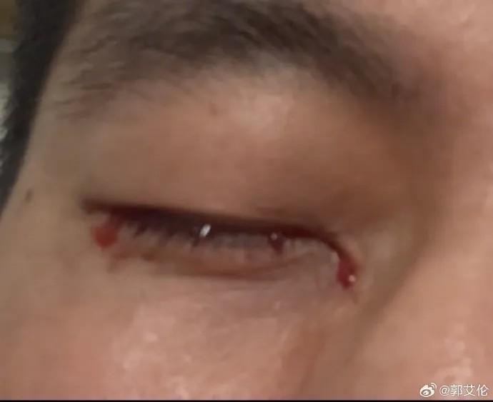 郭艾伦右眼缝合40针发声：被队友刺伤后遭冷漠对