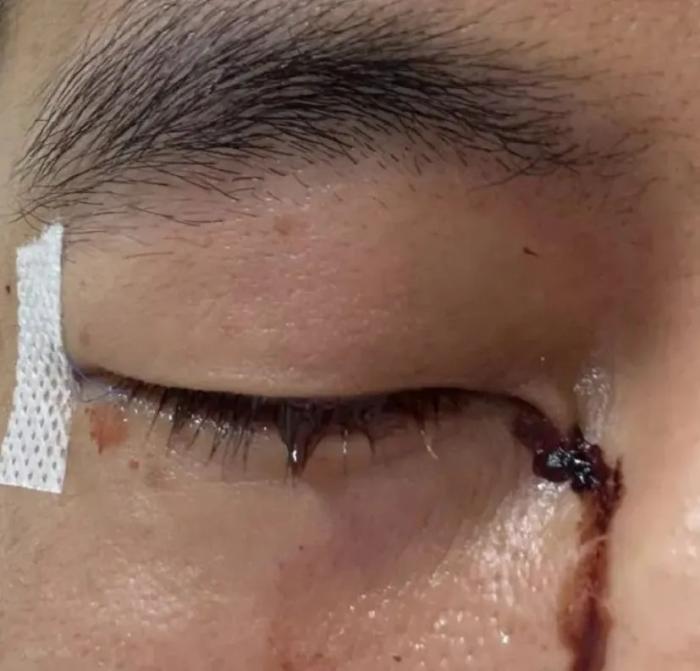 郭艾伦右眼缝合40针发声：被队友刺伤后遭冷漠对